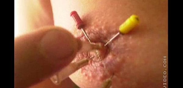  needles in my tit